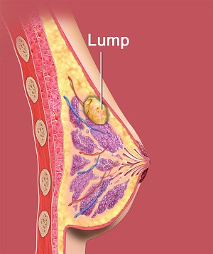 Breast Cancer Lumps: Types, Benign, Causes, and More