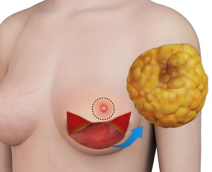 Preventive mastectomy with immediate reconstruction by breast